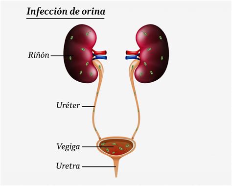 infeccion de vias urinarias